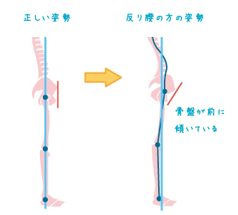 反り腰